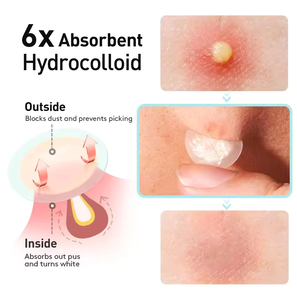 443pcs water-based gel acne pa - Nail Art Remover ulasan dan harga